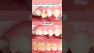 Керамическая коронка на зуб #dental #dentist #стоматология #dentalclinic #dentalcare