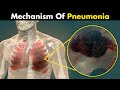 The Mechanism Of Pneumonia - 3D Animation (Urdu/Hindi)