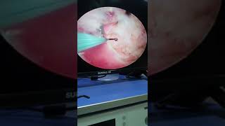 uterine septum حاجز رحمي gubbini system