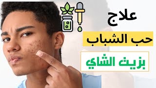 أفضل زيت لعلاج حب الشباب مجرب وفعال