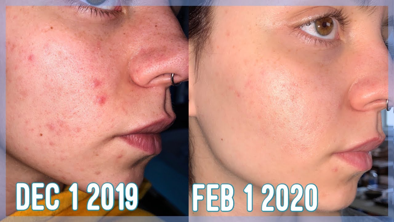 Simple Skincare Routine for Acne | How I cleared my skin - YouTube