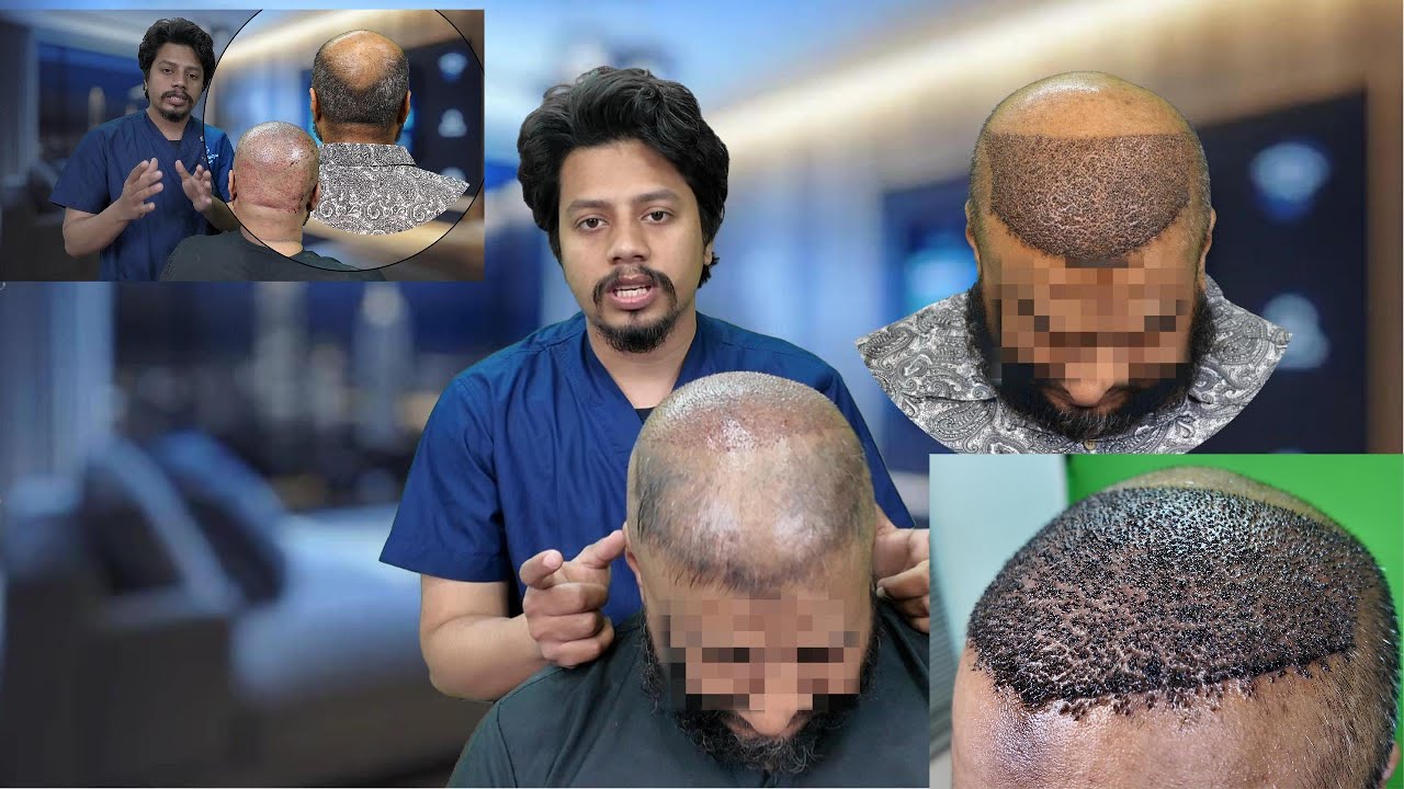 7500 GRAFT MASSIVE HAIR TRANSPLANT. LOWEST BUDGET HAIR TRANSPLANT.  HAIR TRANSPLANT.