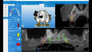 RealGUIDE Software   Implant Planning   Full Arch