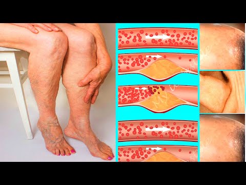 I drank it for 3 days! Say Goodbye To Clogged Arteries and Bad Cholesterol! just 1 Glass IN A.M.!