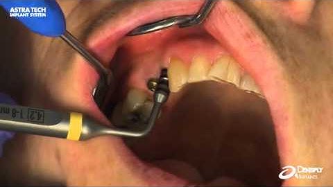 Abutment Depth Gauge EV – Soft tissue measurement | Dentsply Sirona