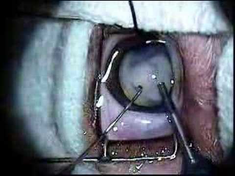 Canine cataract surgery with a lens implant in a dog watch v=4JFmPU50kZY