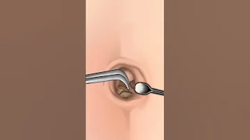 ASMR | Navel Stone Belly Button Ring Remove Animation #asmr #animation #treatment #belly