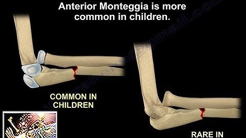 Monteggia Fracture - Everything You Need To Know - Dr. Nabil Ebraheim