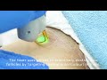Laser Hair Removal Bikini THIS Is How It Works 