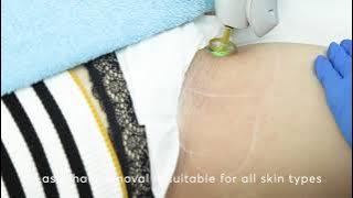 Laser Hair Removal Bikini: THIS is how it works