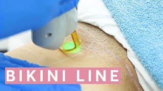Laser Hair Removal Bikini: THIS is how it works