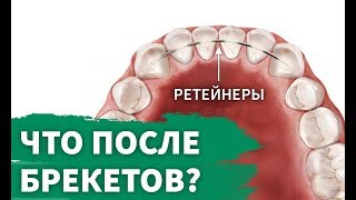 Видео Ретенционный период Что это и как долго длится? (автор: Брекеты от Лаптевой)