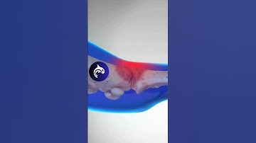 See what Hallux Rigidus of the Foot looks like - #4k #3d #animation