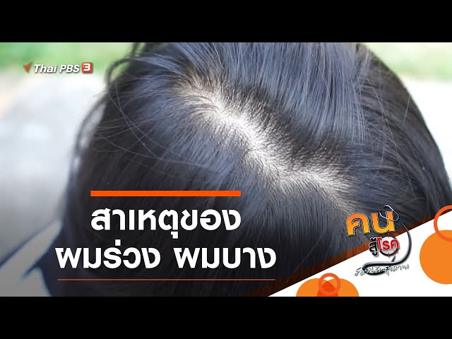 สาเหตุของผมร่วง ผมบาง : รู้สู้โรค (20 เม.ย. 64) - Youtube