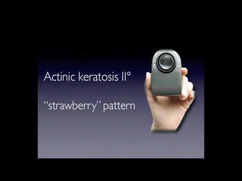 Actinic keratosis (non pigmented) by Dr. Iris Zalaudek