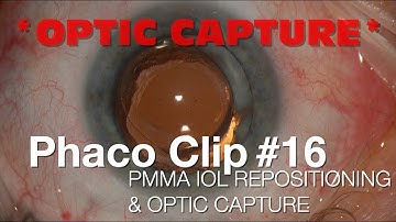 Phaco Clip #16 - PMMA IOL Repositioning & Optic Capture
