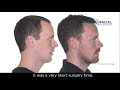 Jaw surgery case  104 johan  sleep apnea maxillomandibular retrusion