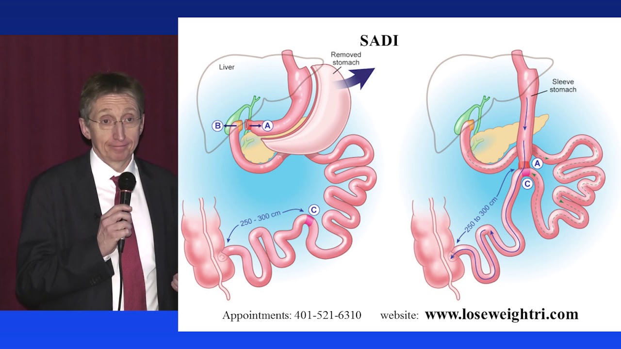 12. RWMC - Bypass, Sleeve, SADI or DS: Which is right for me?