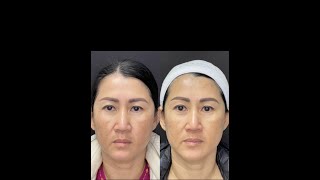 Miracle Microneedling Melasma Treatment by Our Cheryl - Ageless MD