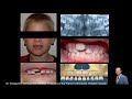 Ddm   le chevauchement des dents  pourquoi traiter jeune entre 3 et 6 ans