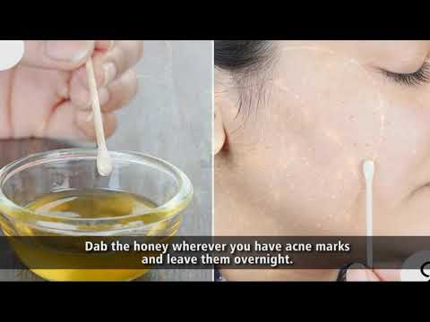 REMOVE ACNE MARKS AT HOME