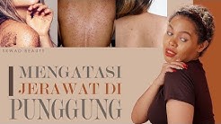 Punggung Banyak Jerawat ?! Begini Cara Menghilangkan Jerawat Di Punggung - Durasi: 5.00. Punggung Banyak Jerawat ?! Begini Cara Menghilangkan Jerawat Di Punggung - Durasi: 5.00.