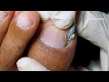 Big ingrown removal/no more pain|satisfying client | Beauty's Skills