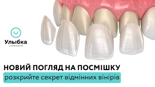 Вініри в Одесі: Майстерність та Естетика для Ідеальної Посмішки