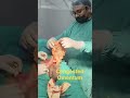 Dx# Left Large Strangulated Inguinal Hernia with omentum as a content,operated successfully.