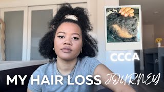 MY HAIR LOSS JOURNEY ~ I HAVE CCCA ALOPECIA