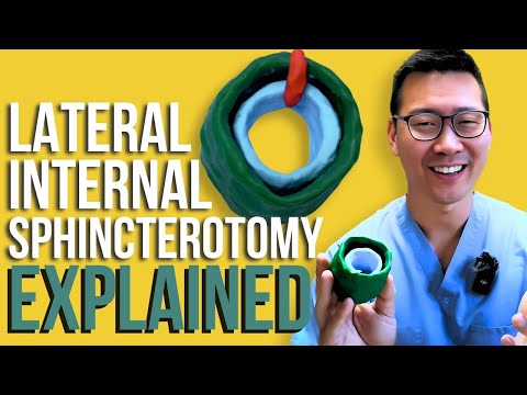 How the LIS is done! | Anal Fissure surgery
