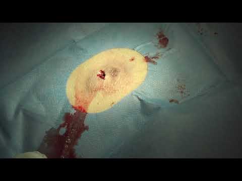 Incision of an abscess