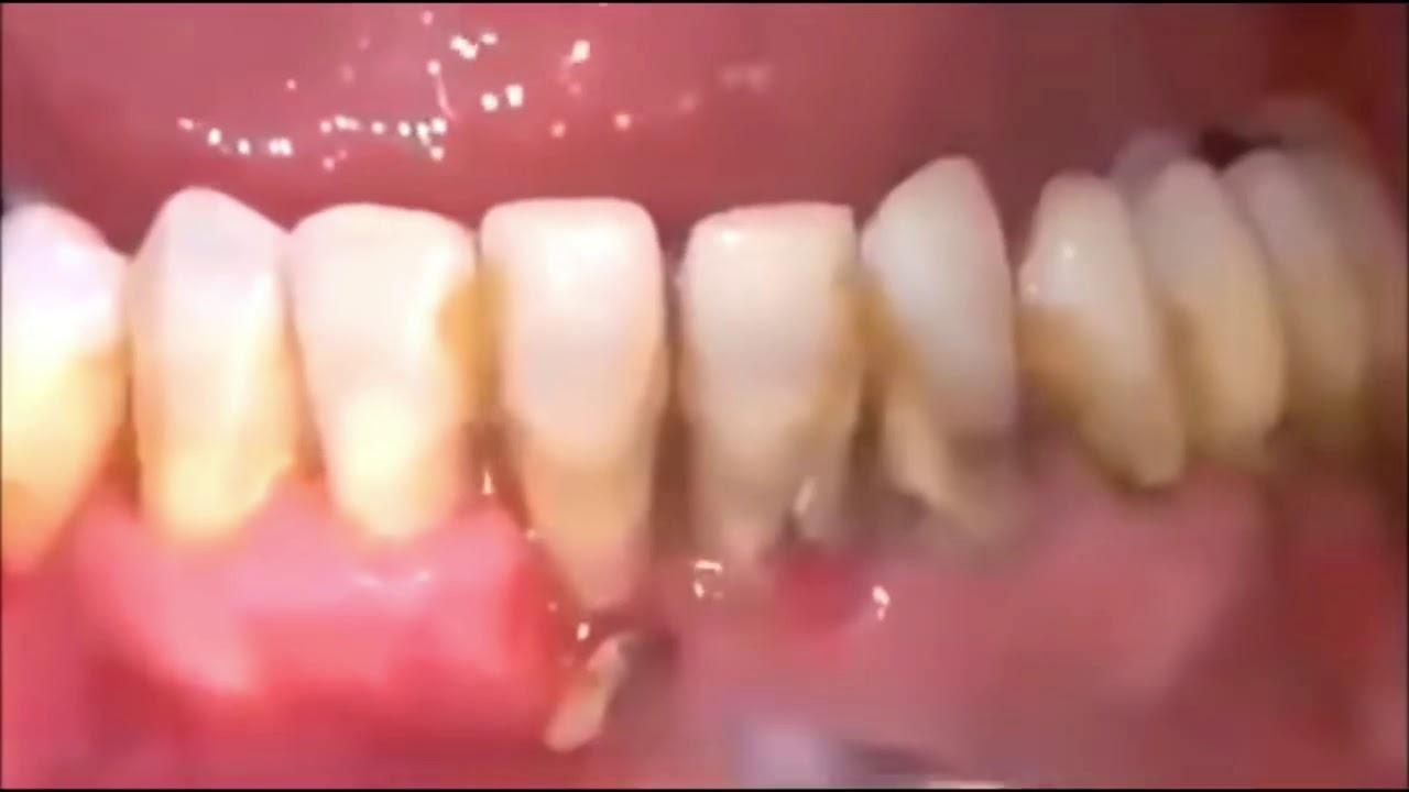 Most Satisfying Teeth Cleaning (Satisfying Video) YouTube