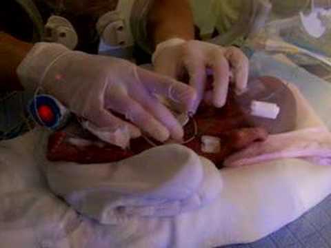 ANGEL Preemie Noah 2 days after birth