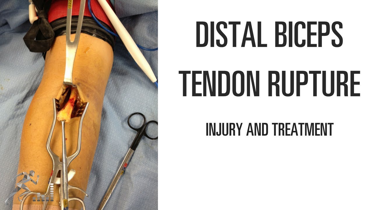 Distal Biceps Tendon Rupture Mechanism Of Injury And Treatment YouTube