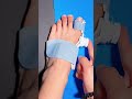 Big foot bones, thumb valgus, many people are still unaware of using this regulator.