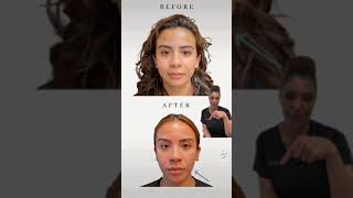 The Benefits of Masseter Botox