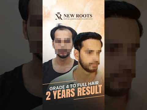 Hair Transplant Cost and Best Results | New Roots #shorts #hair #viral