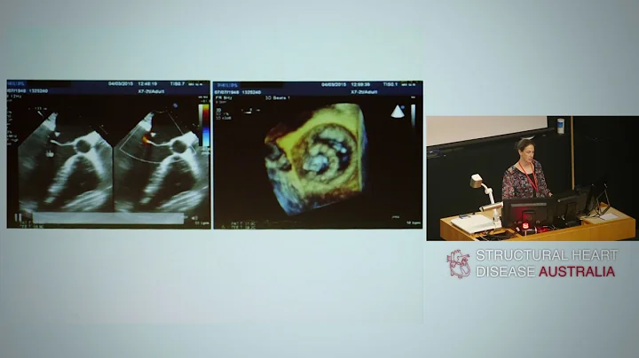 Quantification of mitral regurgitation - Dr Lisa S...