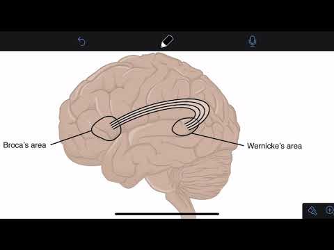 Video: Progressive Aphasie behandeln: 10 Schritte (mit Bildern)