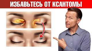 видео: Как избавиться от ксантомы век в домашних условиях? картинка: Как избавиться от ксантомы век в домашних условиях?