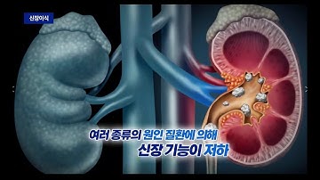 [메디컬플러스] 신장이식 _ 송상현 교수(단국대병원 외과)