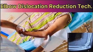 Elbow Dislocation Reduction |How to Reduce Posterior Dislocation Elbow with patient in Supine positn