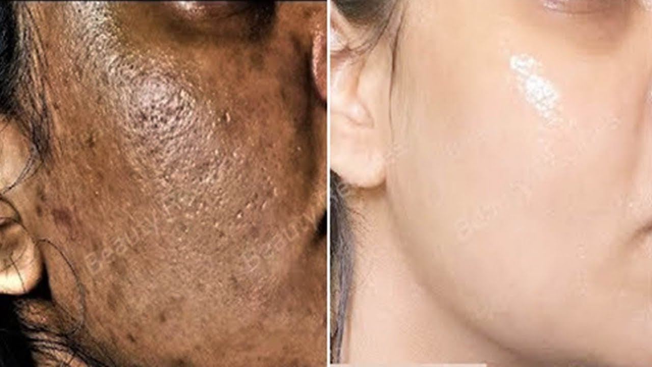 सर्त लगालो ये चीजे चेहरे का कालापन, दाग-धब्बे निशान हमेशा के लिए हटा के गोरा बना देगी | Gorapan skin whitening home remedies with besan