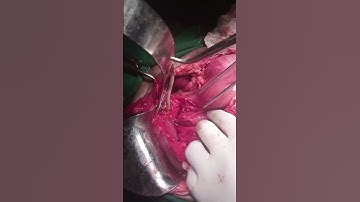 Perforasi kandung empedu akibat infestasi cacing gelang - Video tambahan [ID 421611]