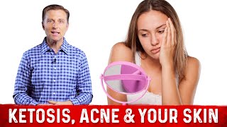 Is Skin Acne and Ketosis have any connection? Explained By Dr.Berg