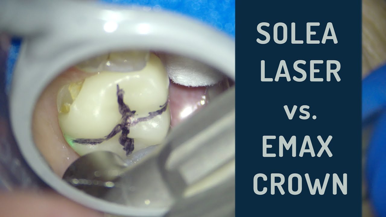 Laser removal of bonded crowns YouTube