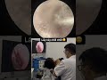 Deep Earwax Suction Procedure 👂🔥 | Safe ENT Cleaning #Doctor #EarCare #ViralVideo
