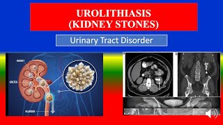 UROLITHIASIS  (KIDNEY STONES) - Definition, types, causes, pathophysiology,  diagnoses , medicine screenshot 4