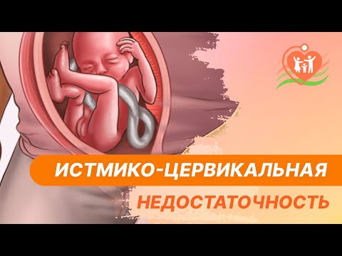 💁‍♀️ Истмико-цервикальная недостаточность